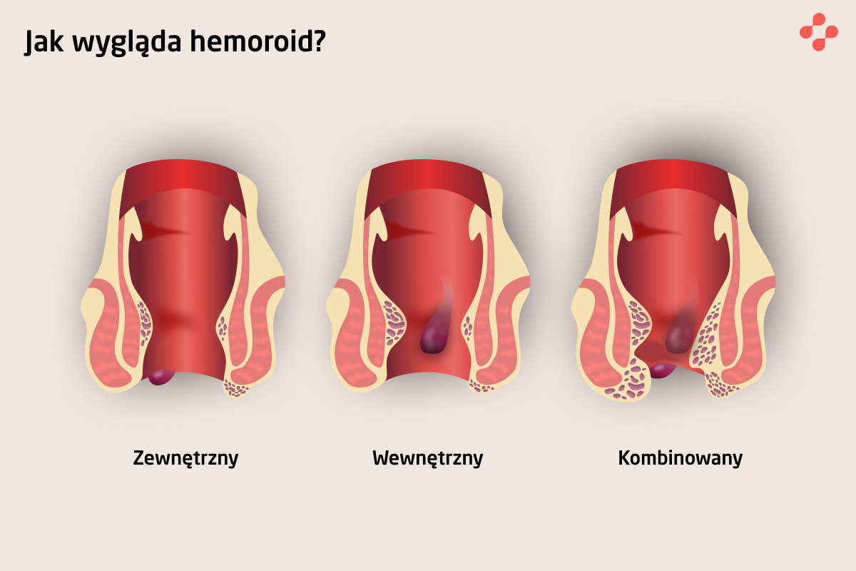Objawy Hemoroidów I Metody Ich Leczenia Blog Centrum Medycznego Doctorpro 5501