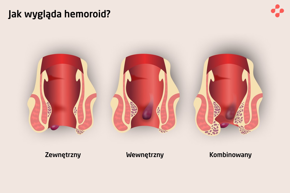 Jak wygląda hemoroid?