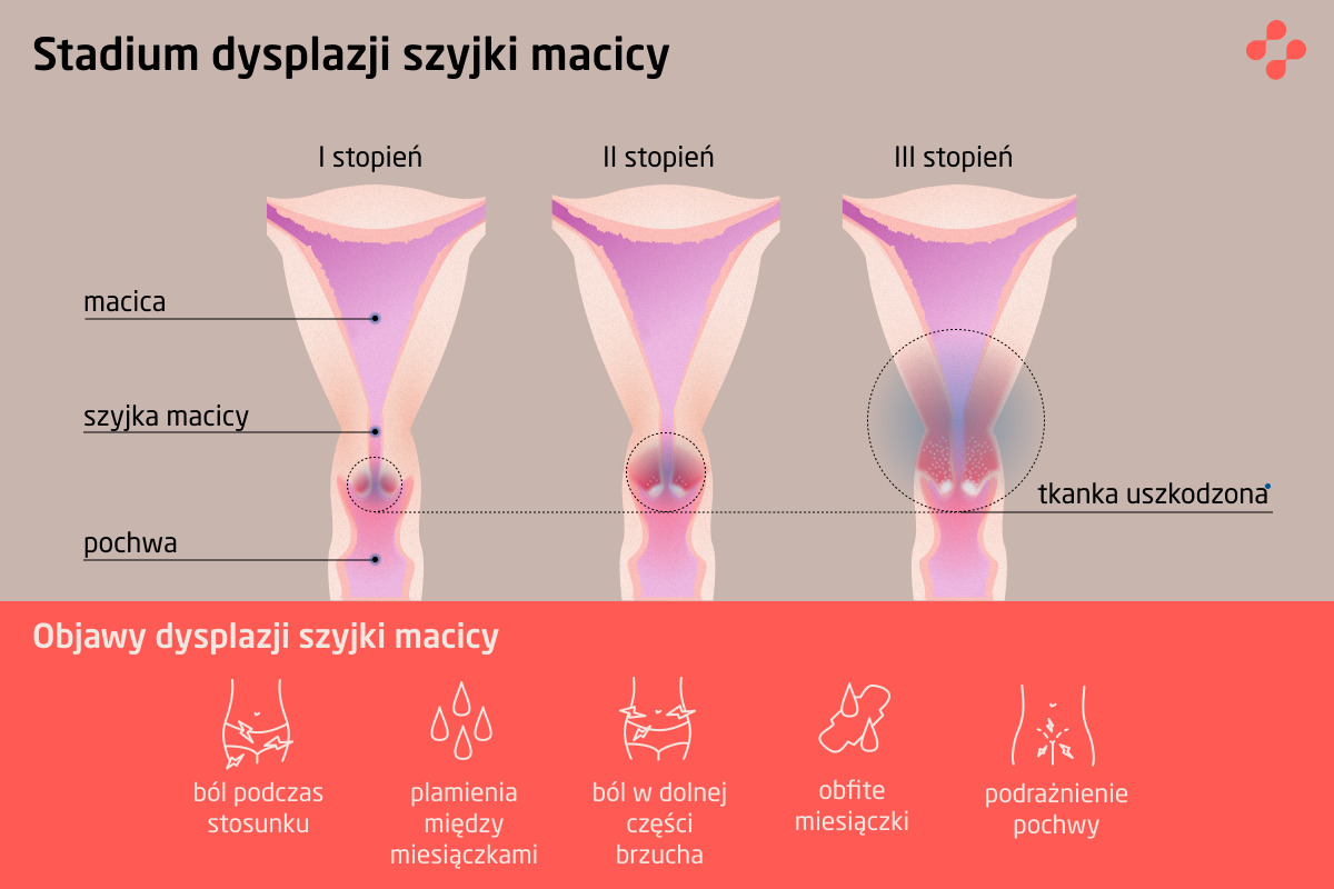 Stadium dysplazji szyjki macicy