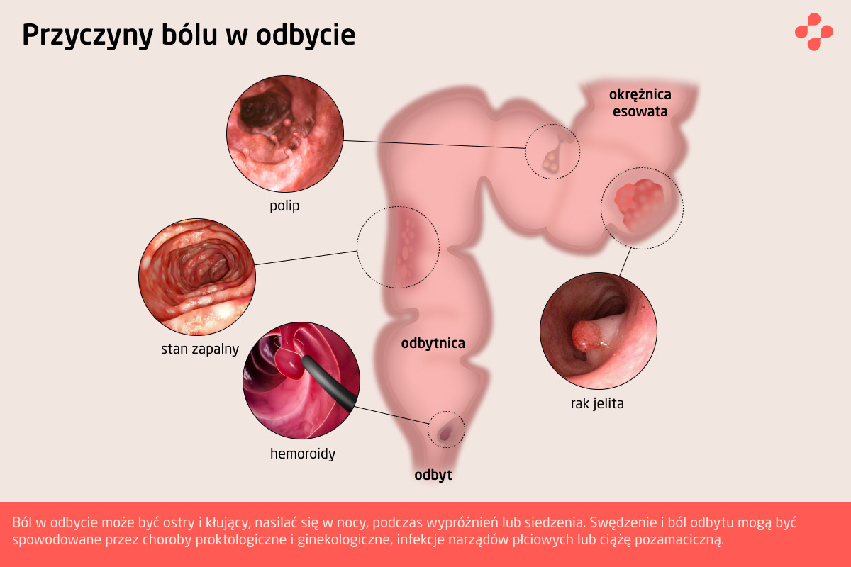 Przyczyny bólu w odbycie