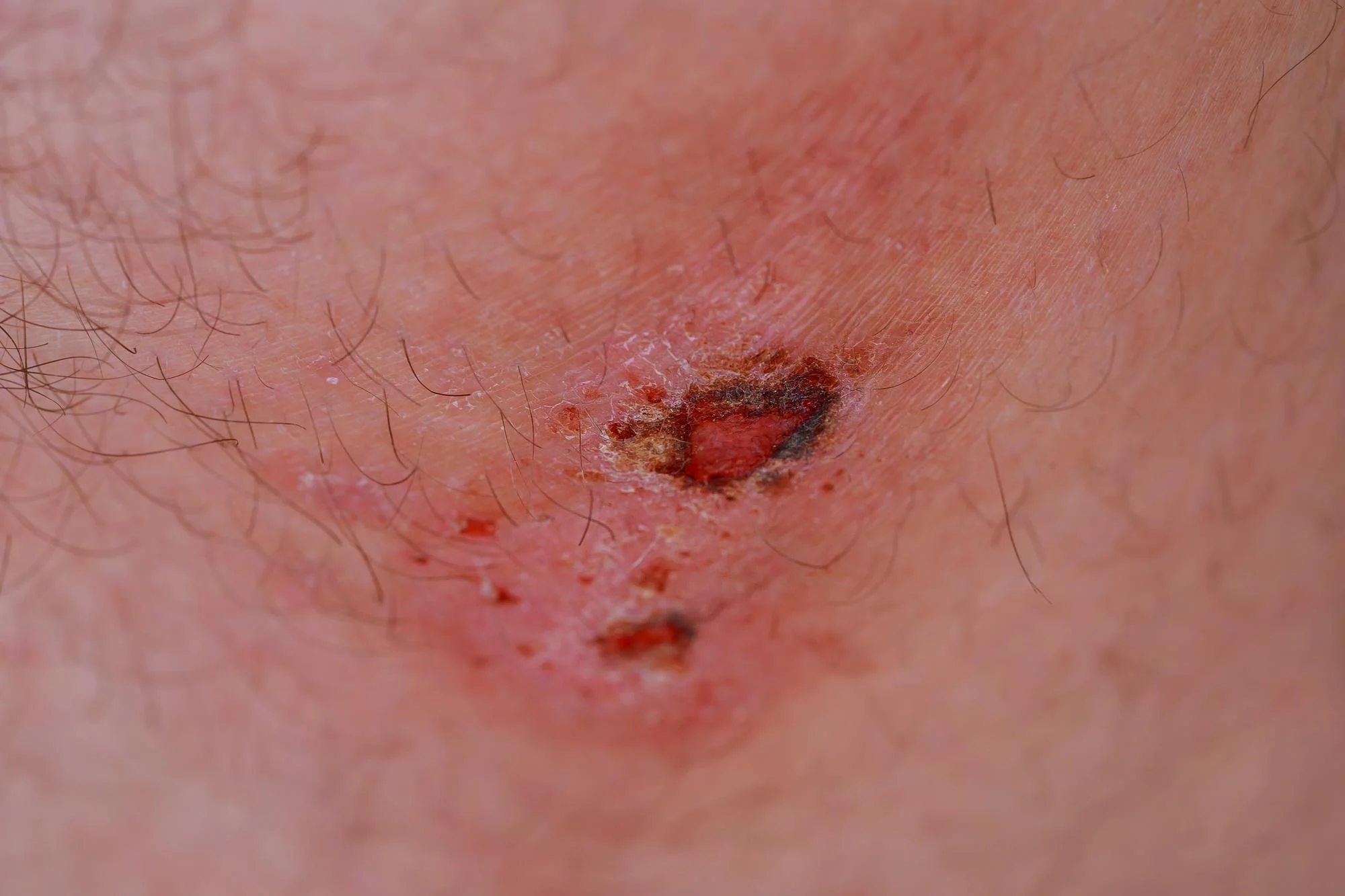 Wrzód kiły na brzuchu