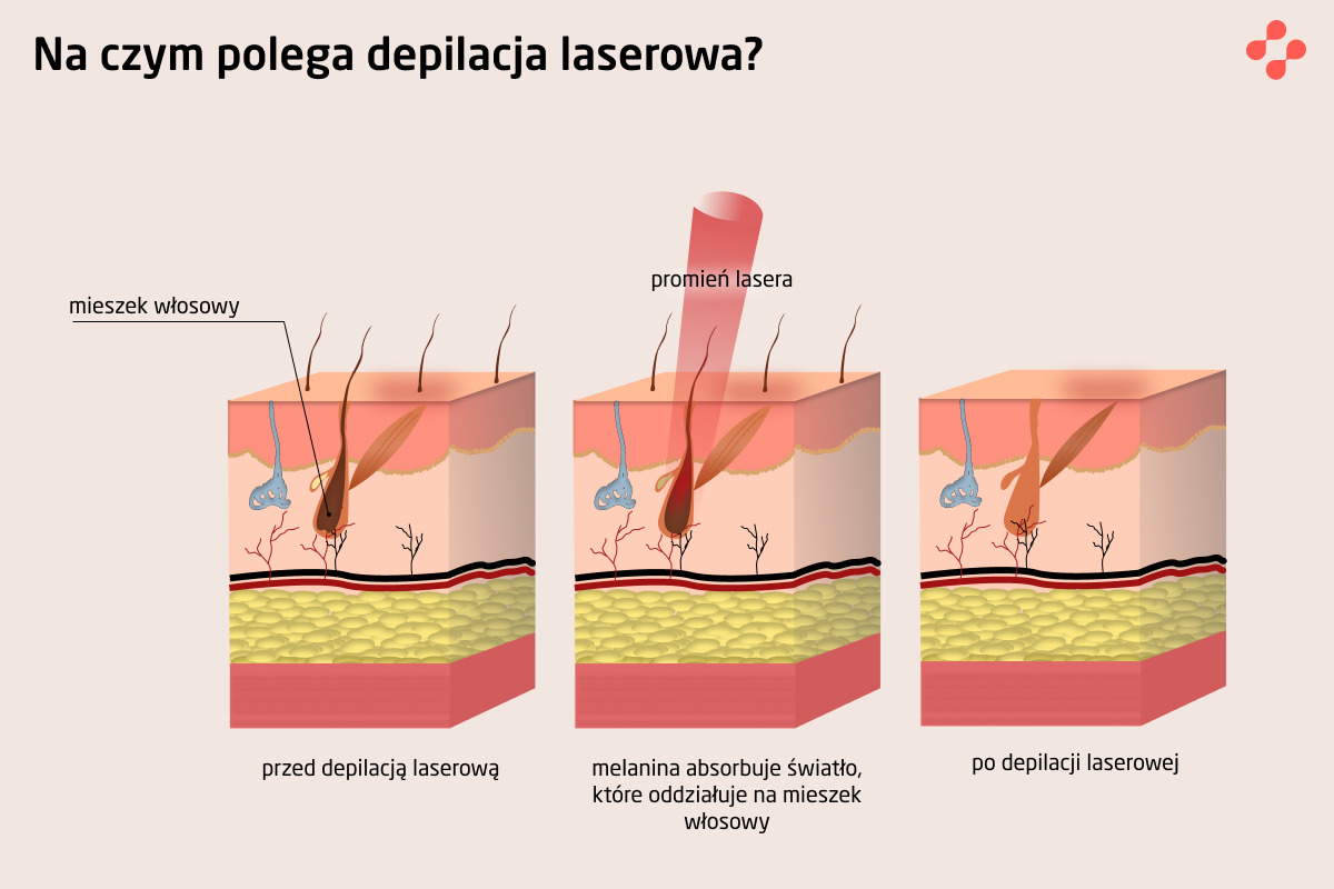 Na czym polega depilacja laserowa?