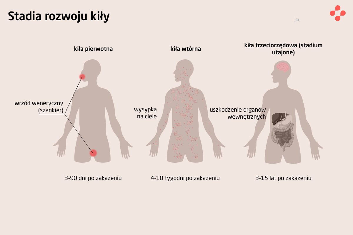 Stadia rozwoju kiły