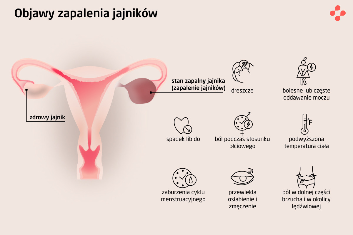 Objawy zapalenia jajników