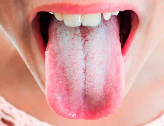 Helicobacter na języku