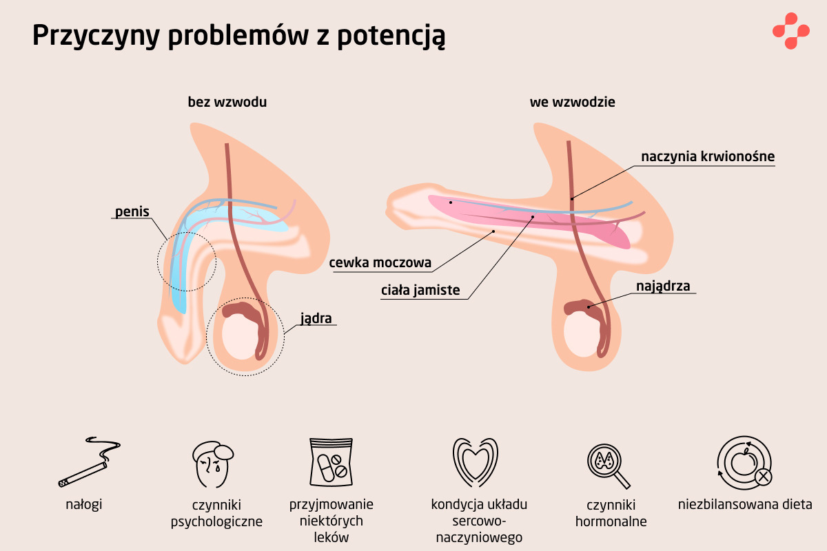 Przyczyny problemów z potencją