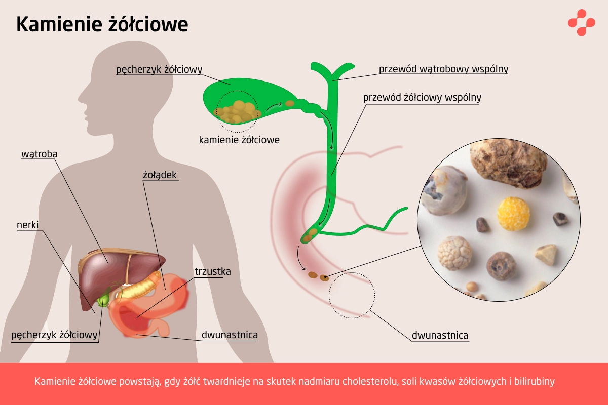 Kamienie żółciowe