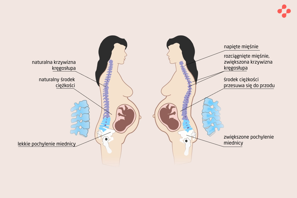 Ból Pleców W Ciąży — Blog Centrum Medycznego Doctorpro 4535