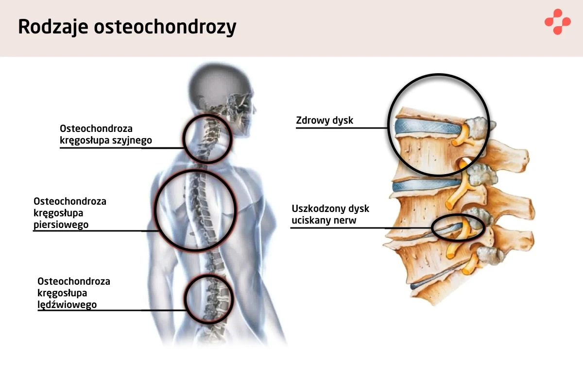 Rodzaje osteochondrozy