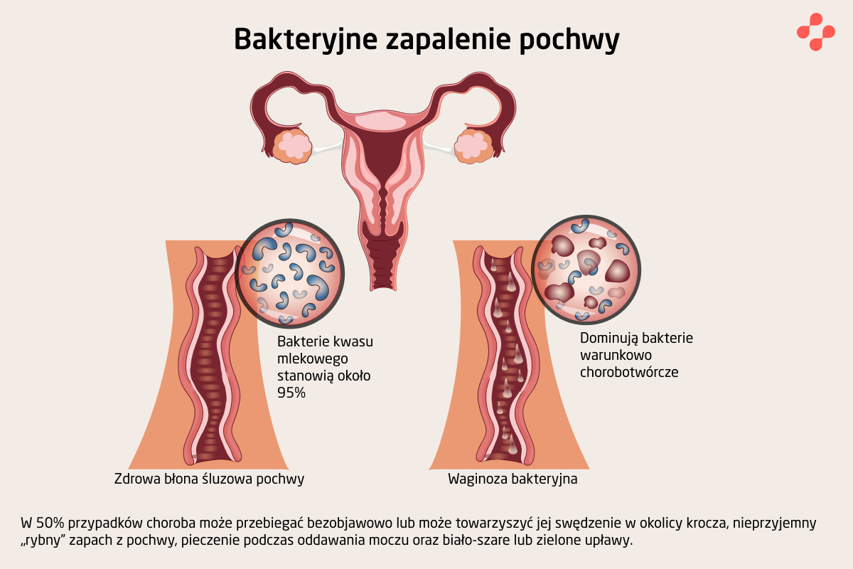 Przyczyny waginozy bakteryjnej