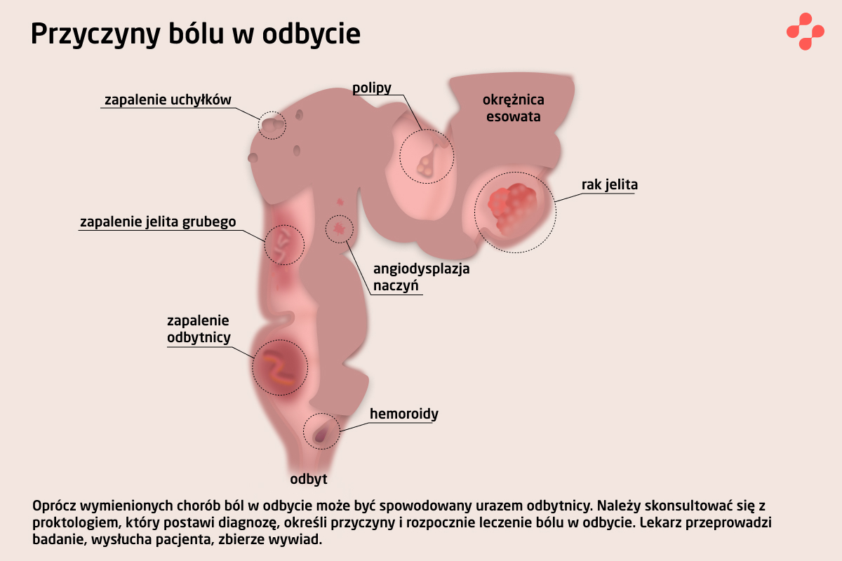 Przyczyny bólu odbytu
