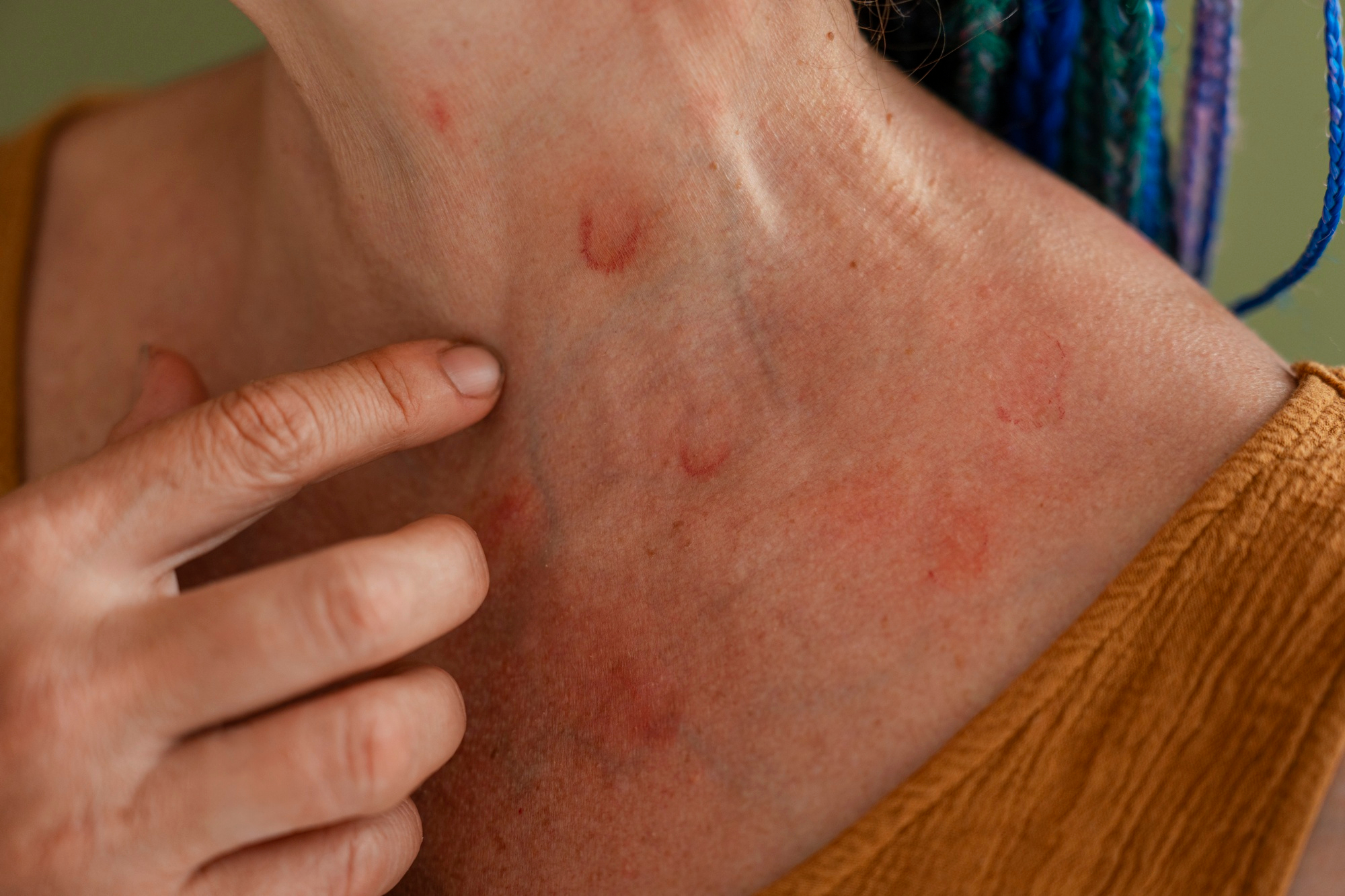 Piodermia