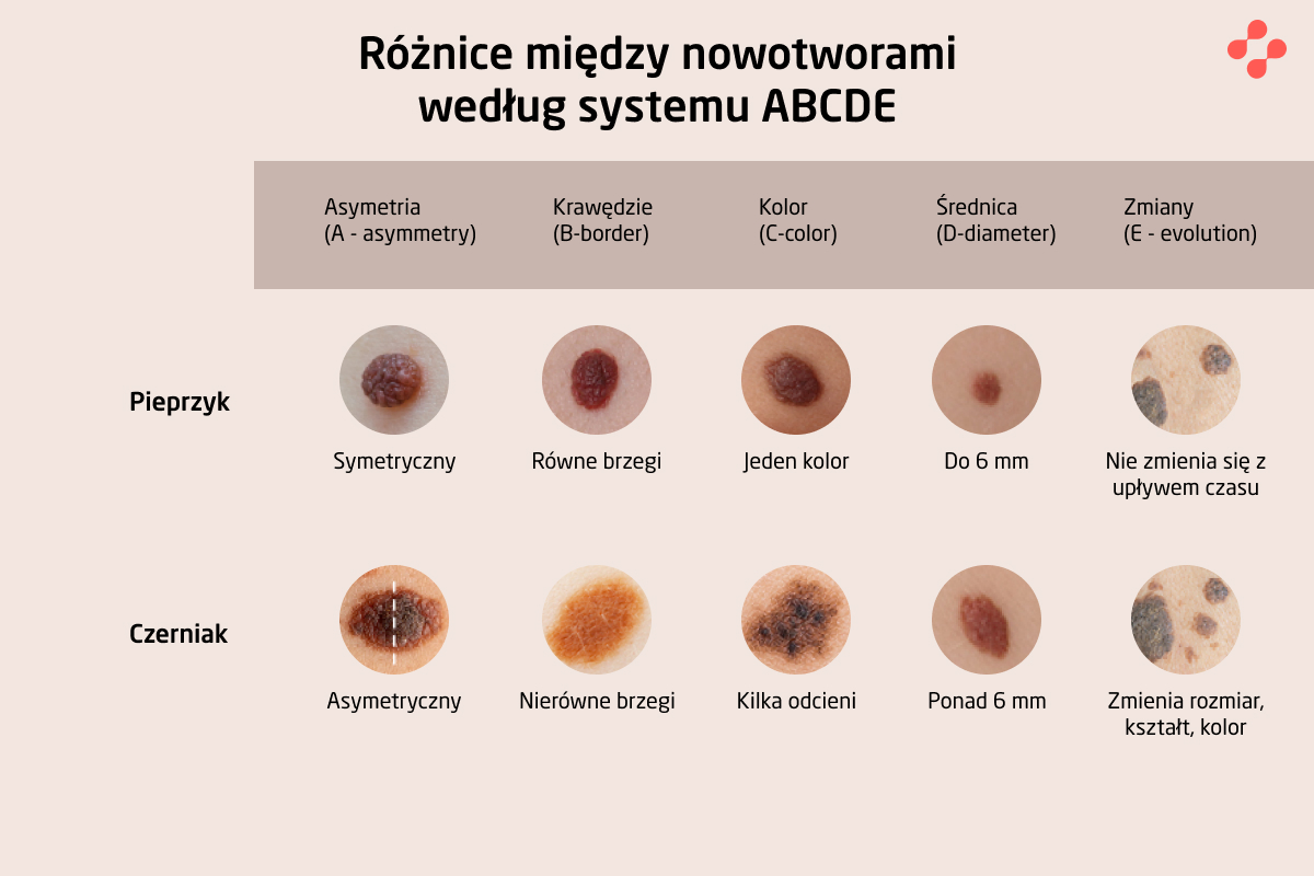 Objawy czerniaka