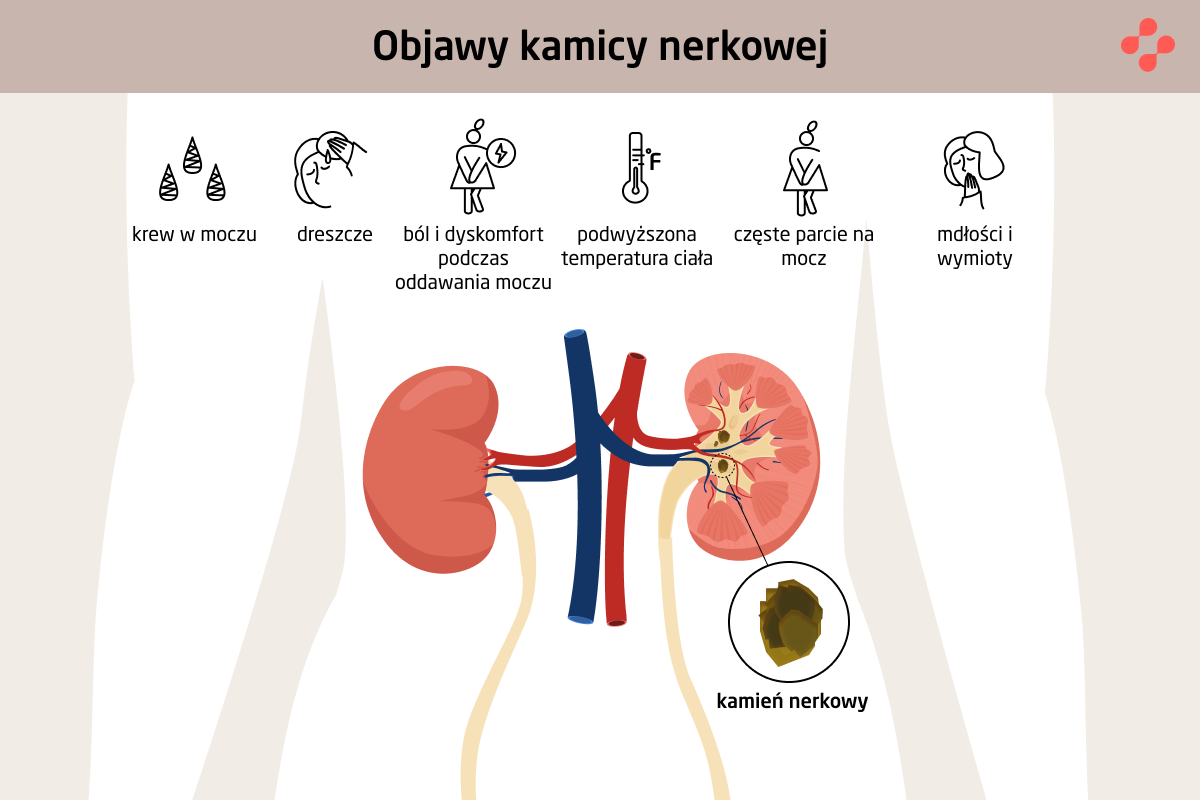 Rodzaje i objawy kamieni nerkowych